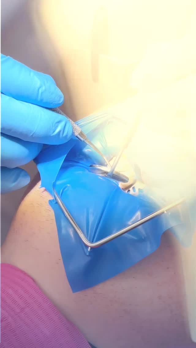 Лечение пульпита